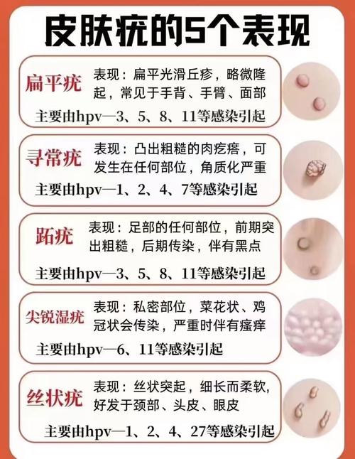 什么叫HPV病毒感染